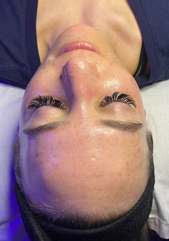 HydraFacial — after, patient 1