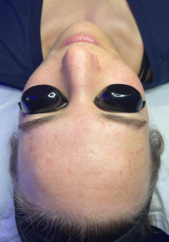 HydraFacial — before, patient 1