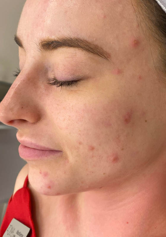VI Chemical Peel — before, patient 1