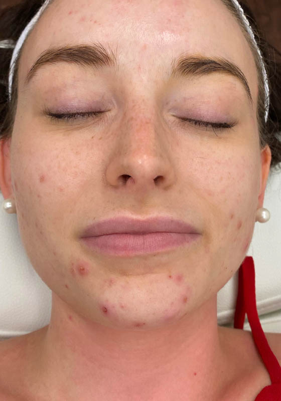 VI Chemical Peel — before, patient 2