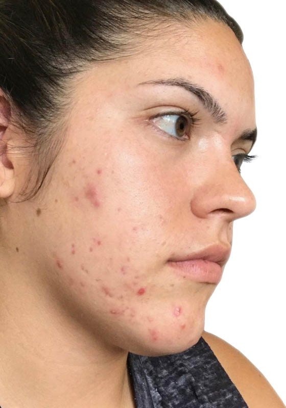 Microneedling & PRP — before, patient 1