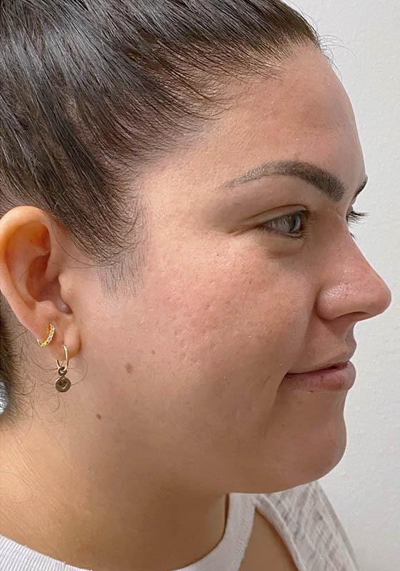 Microneedling & PRP — after, patient 1