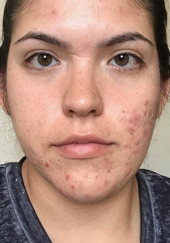 Microneedling & PRP — before, patient 2