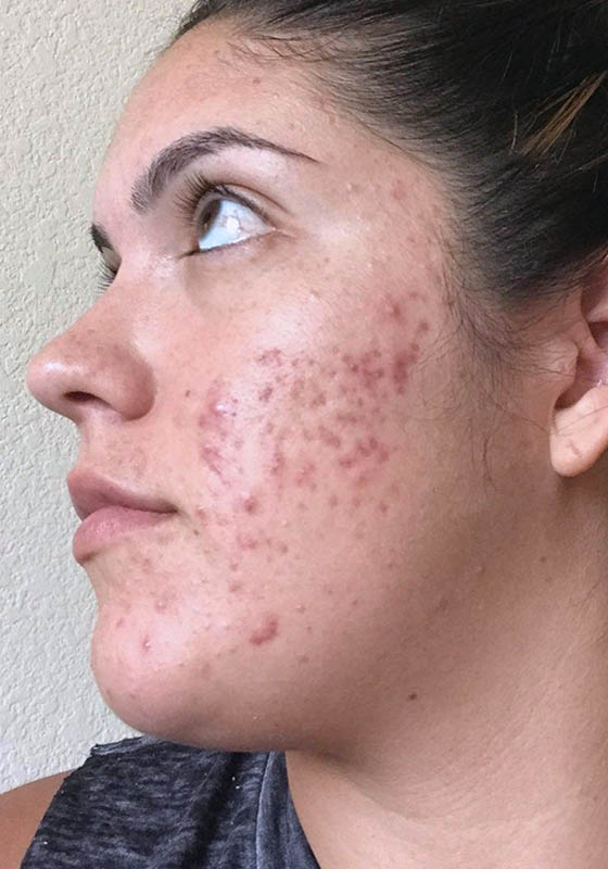 Microneedling & PRP — before, patient 3