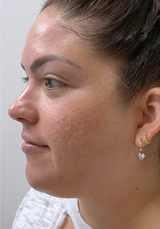 Microneedling & PRP — after, patient 3