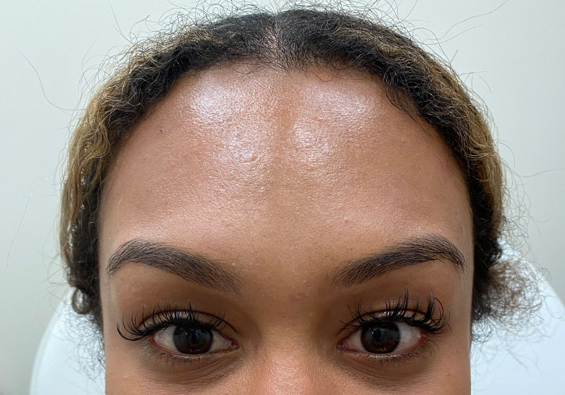 Botox & Dysport — after, patient 4