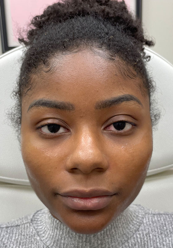 Cheek Augmentation — after, patient 1