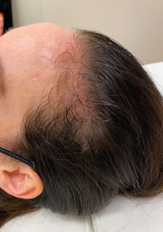Hair Restoration — before, patient 3