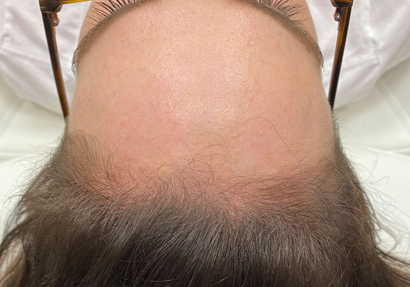 Hair Restoration — after, patient 1