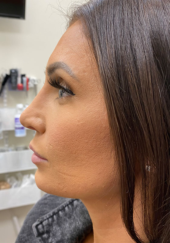 Jawline & Chin Filler — before, patient 5