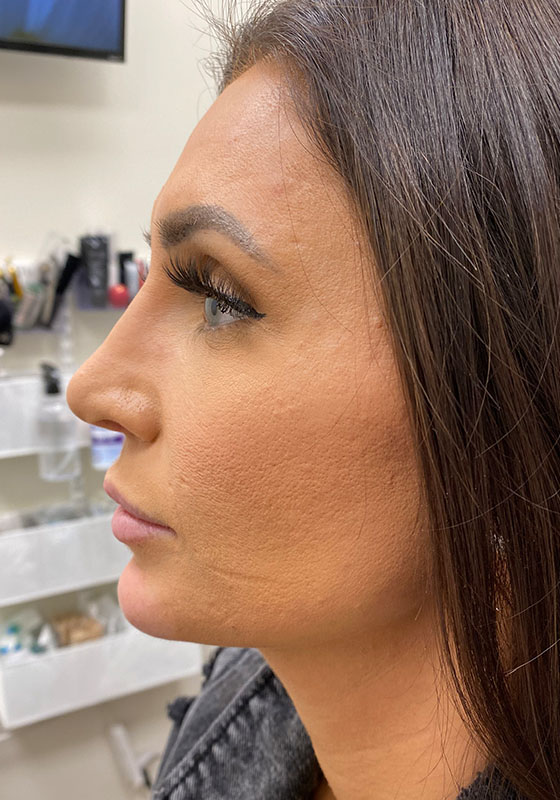 Jawline & Chin Filler — after, patient 5