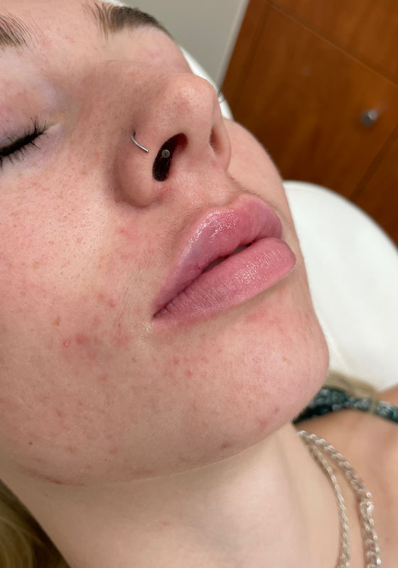 Lip Enhancement — after, patient 1