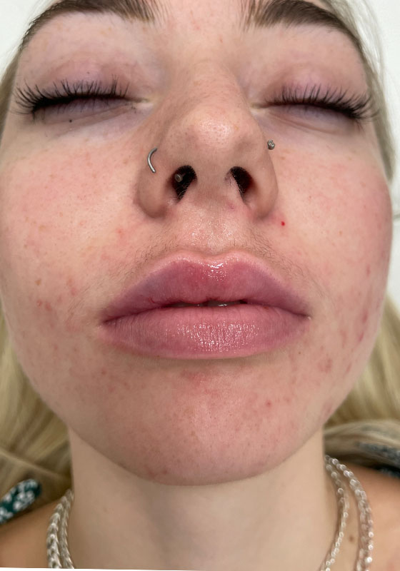 Lip Enhancement — after, patient 2