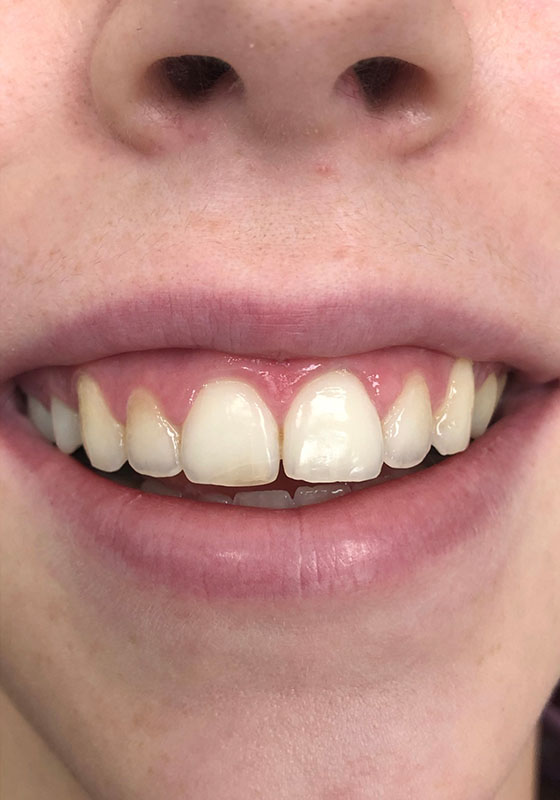 Lip Enhancement — before, patient 3
