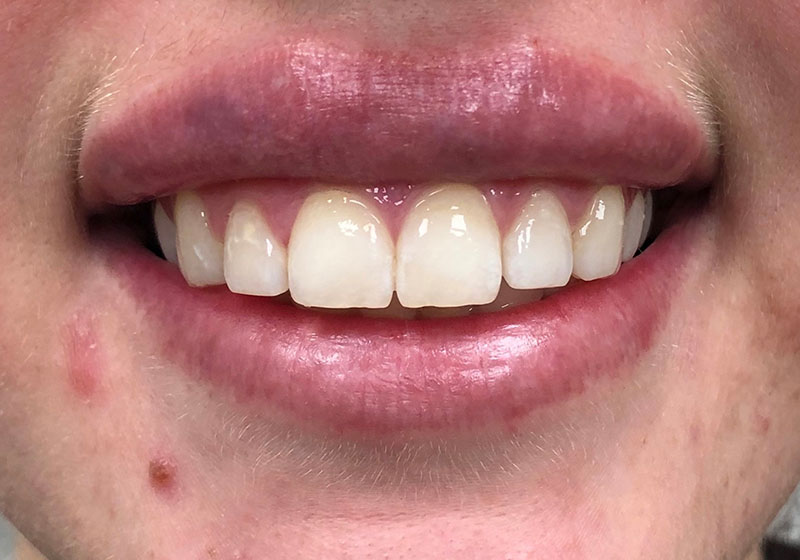 Lip Enhancement — after, patient 4