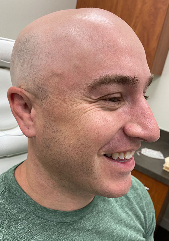 Botox & Dysport — before, patient 5
