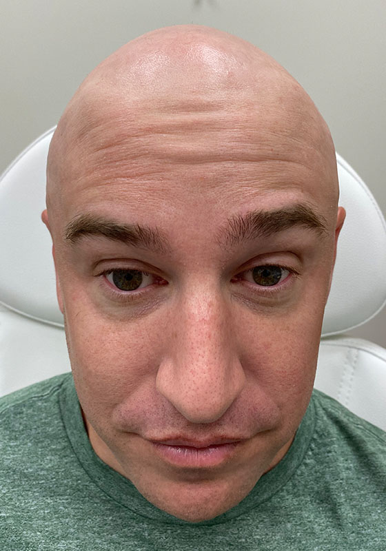 Botox & Dysport — before, patient 7