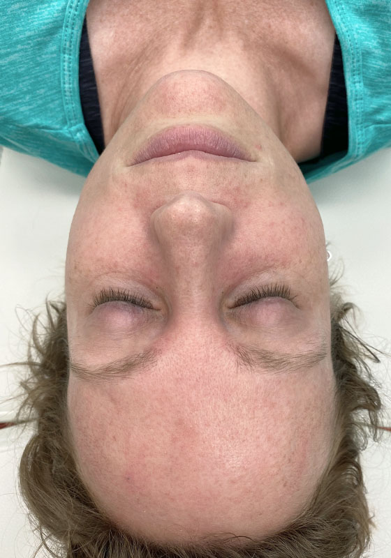 IPL Photofacial — before, patient 1