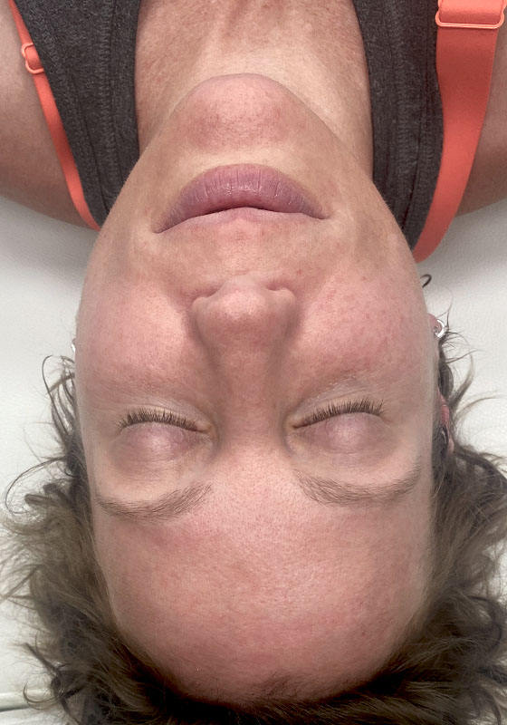 IPL Photofacial — after, patient 1