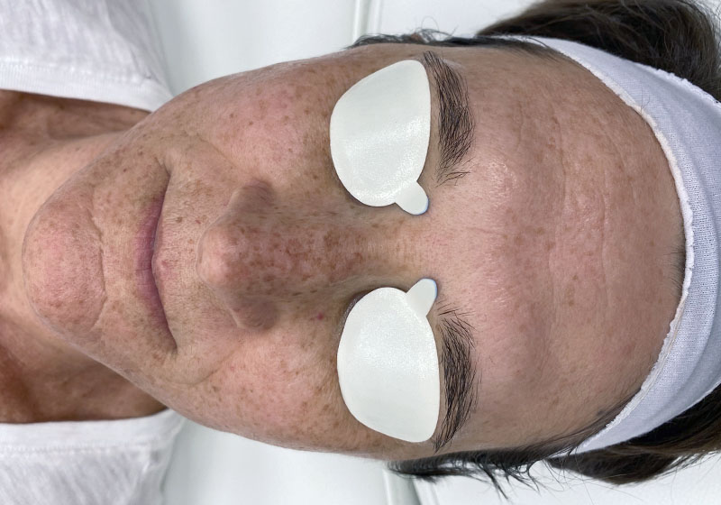 IPL Photofacial — before, patient 3