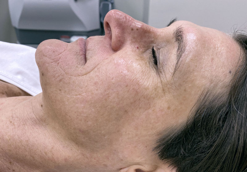 IPL Photofacial — after, patient 2