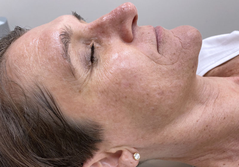 IPL Photofacial — after, patient 4