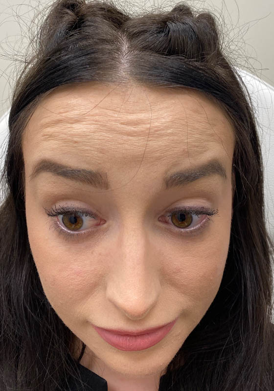 Botox & Dysport — before, patient 8