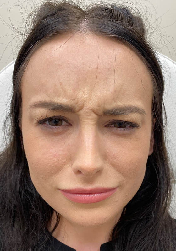 Botox & Dysport — before, patient 9
