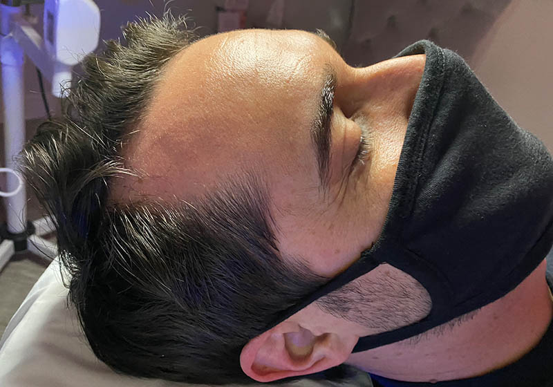 Hair Restoration — before, patient 4