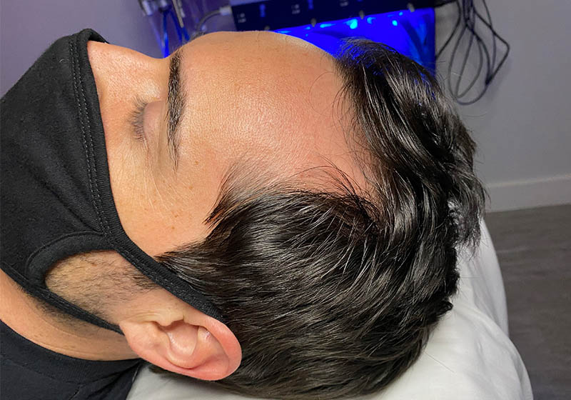 Hair Restoration — before, patient 5