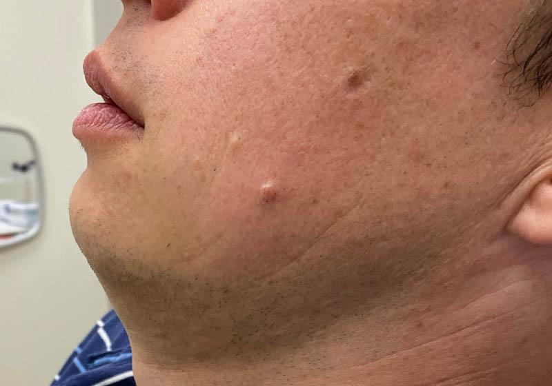 Jawline & Chin Filler — before, patient 6