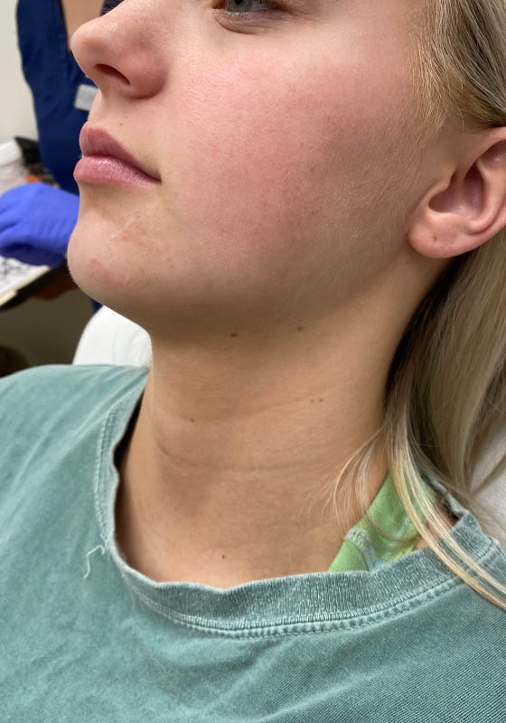 Jawline & Chin Filler — before, patient 7
