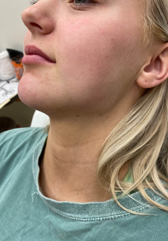 Jawline & Chin Filler — after, patient 7