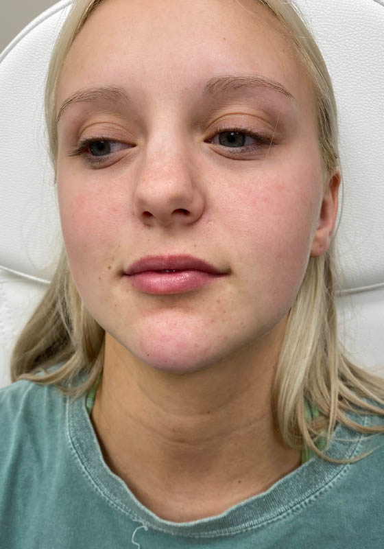 Jawline & Chin Filler — after, patient 8