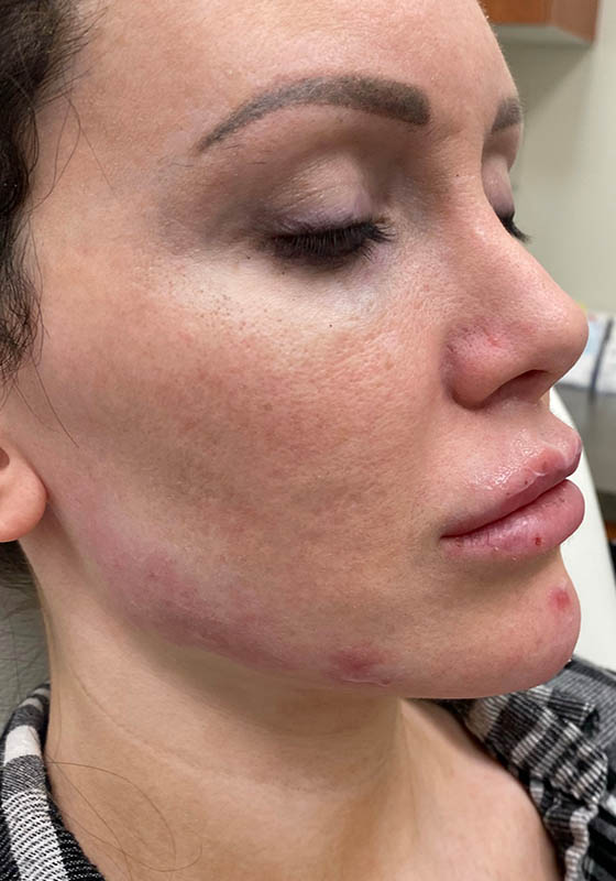 Jawline & Chin Filler — after, patient 9