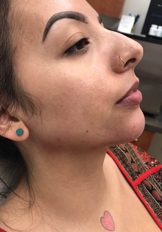 Jawline & Chin Filler — after, patient 1