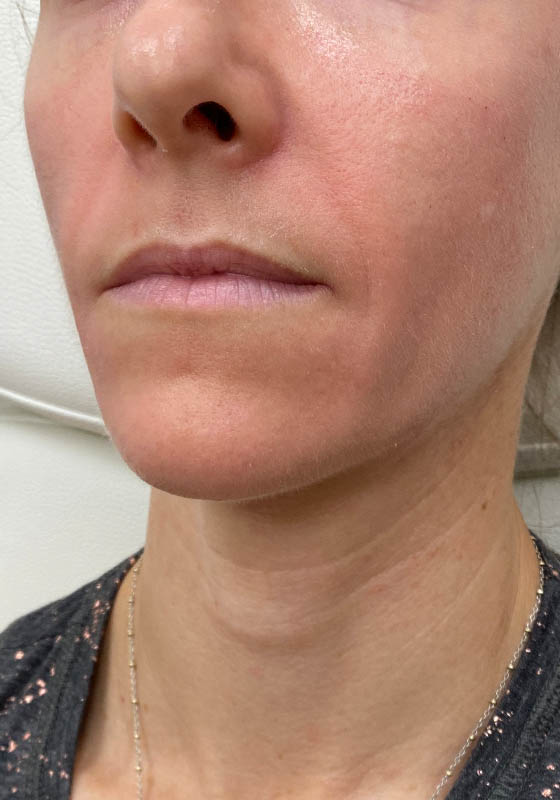 Smile Lines — before, patient 1