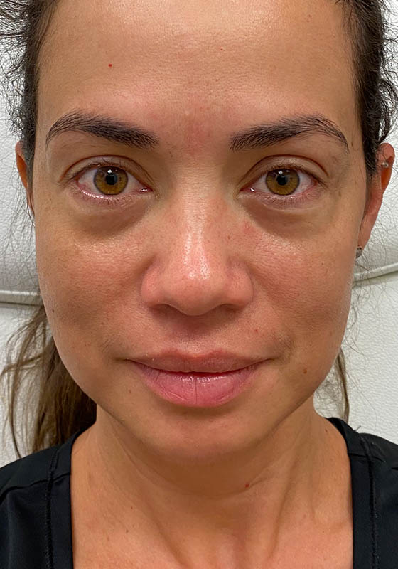 Tear Troughs — before, patient 1