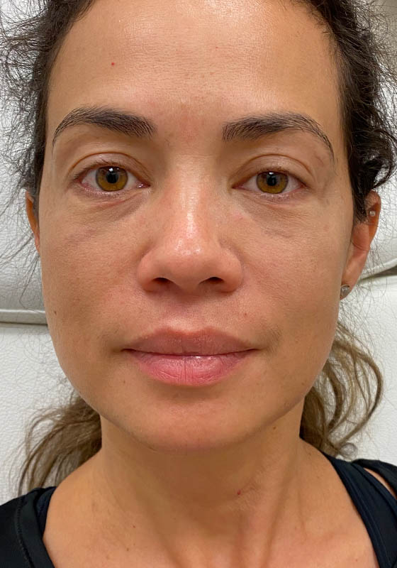 Tear Troughs — after, patient 1