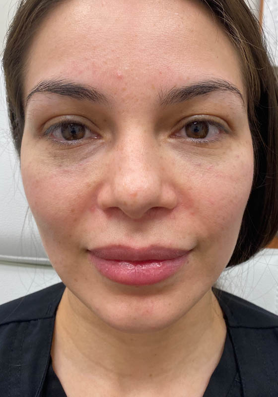 Tear Troughs — after, patient 2