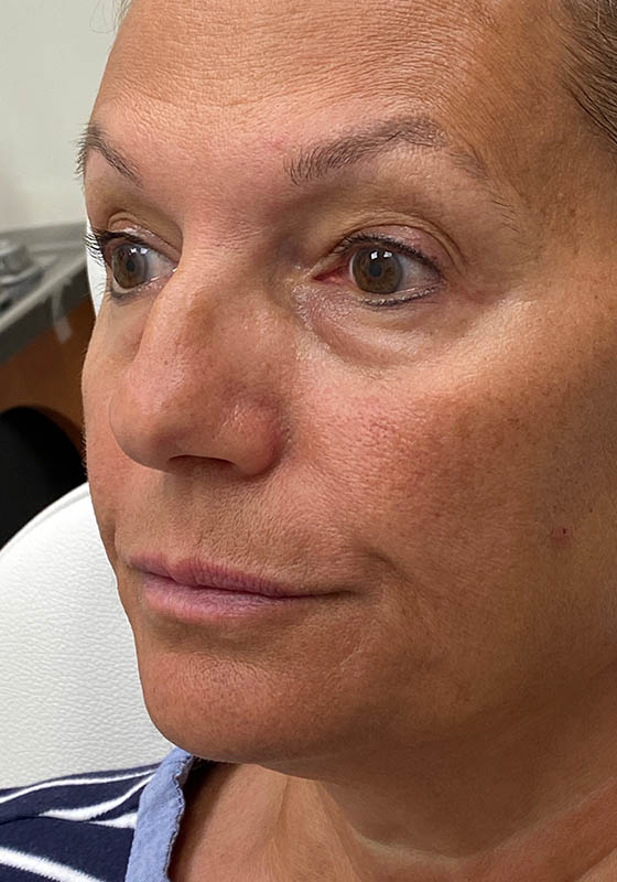 Tear Troughs — after, patient 3