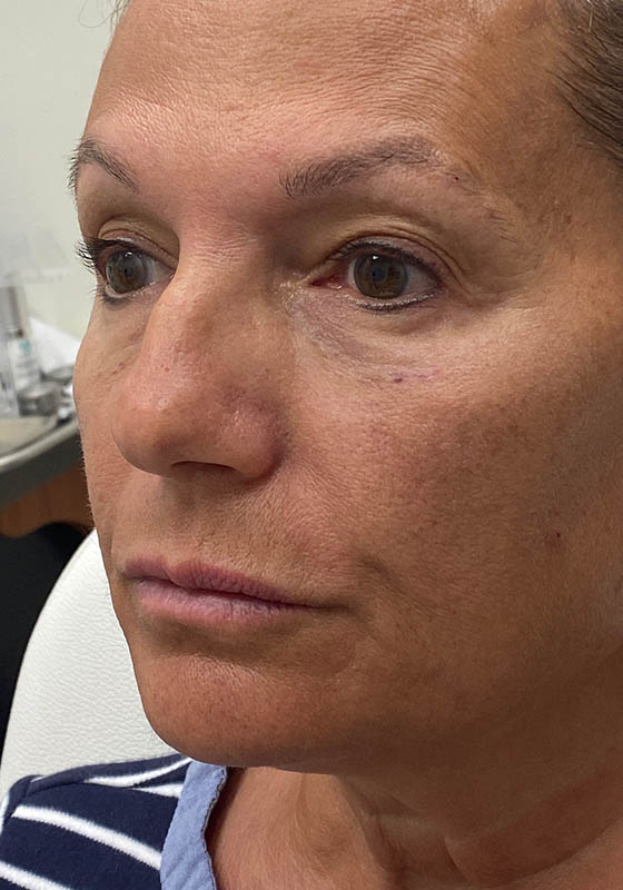 Tear Troughs — before, patient 3