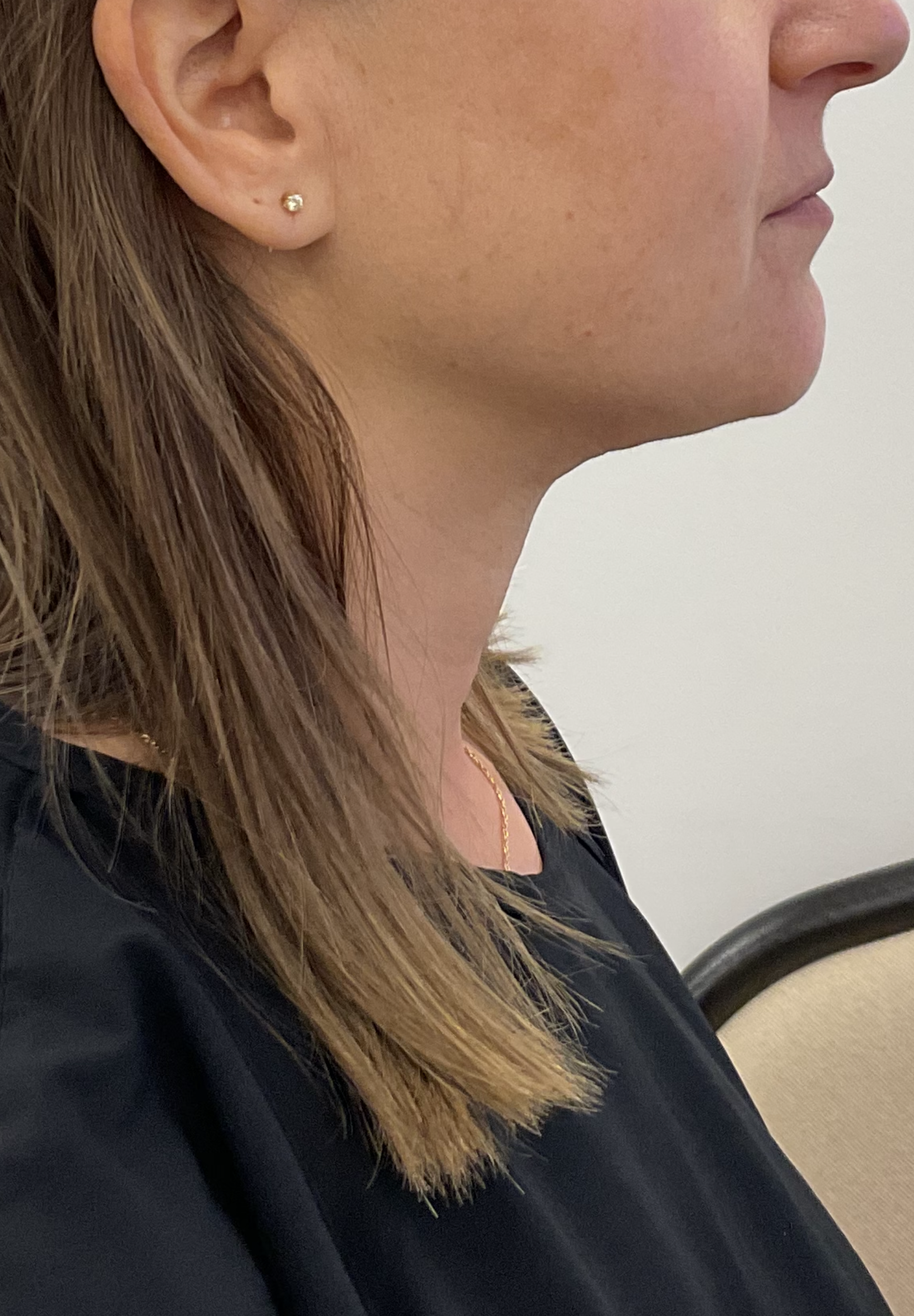 SmartLipo — after, patient 2