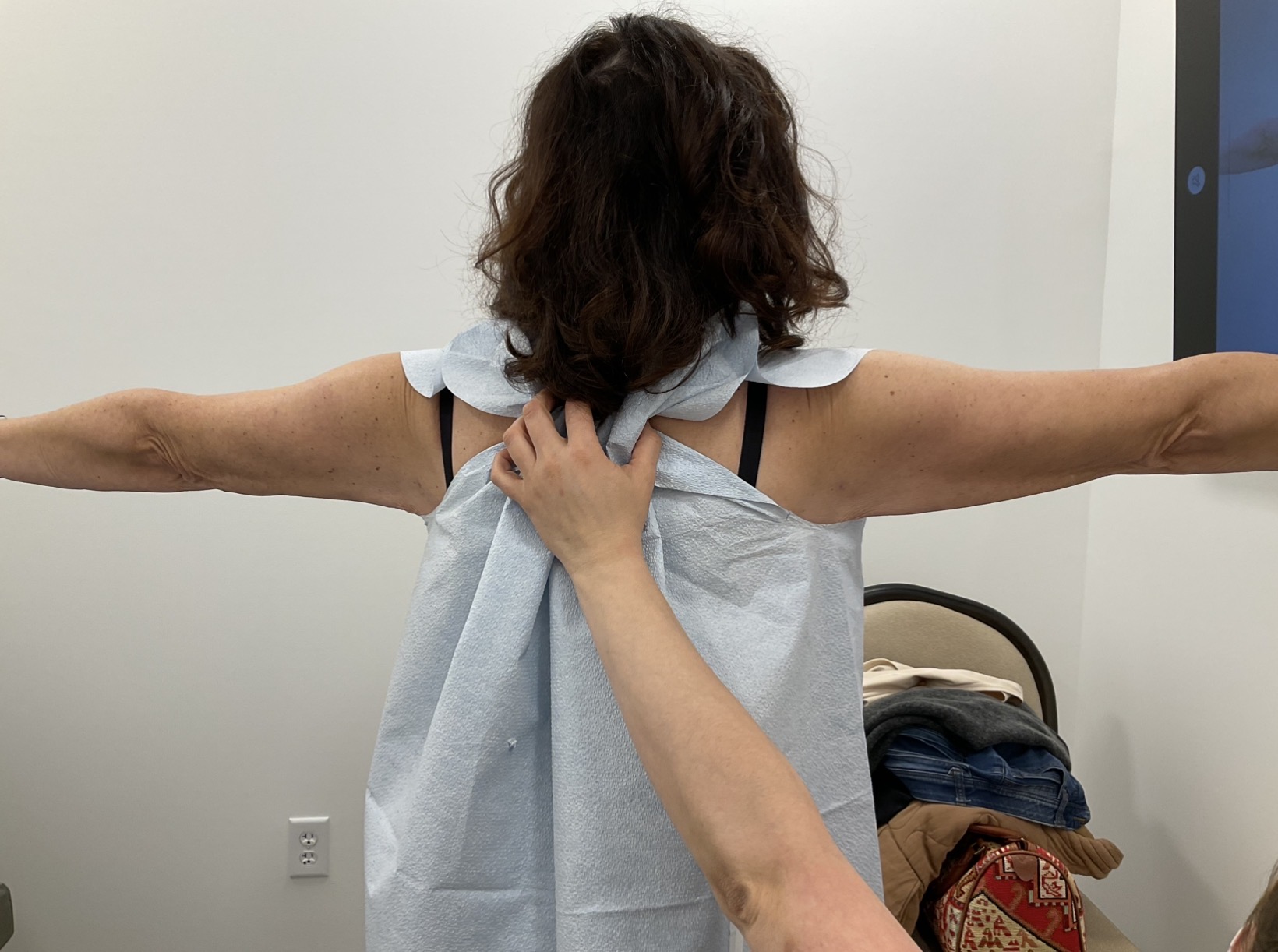 SmartLipo — after, patient 4