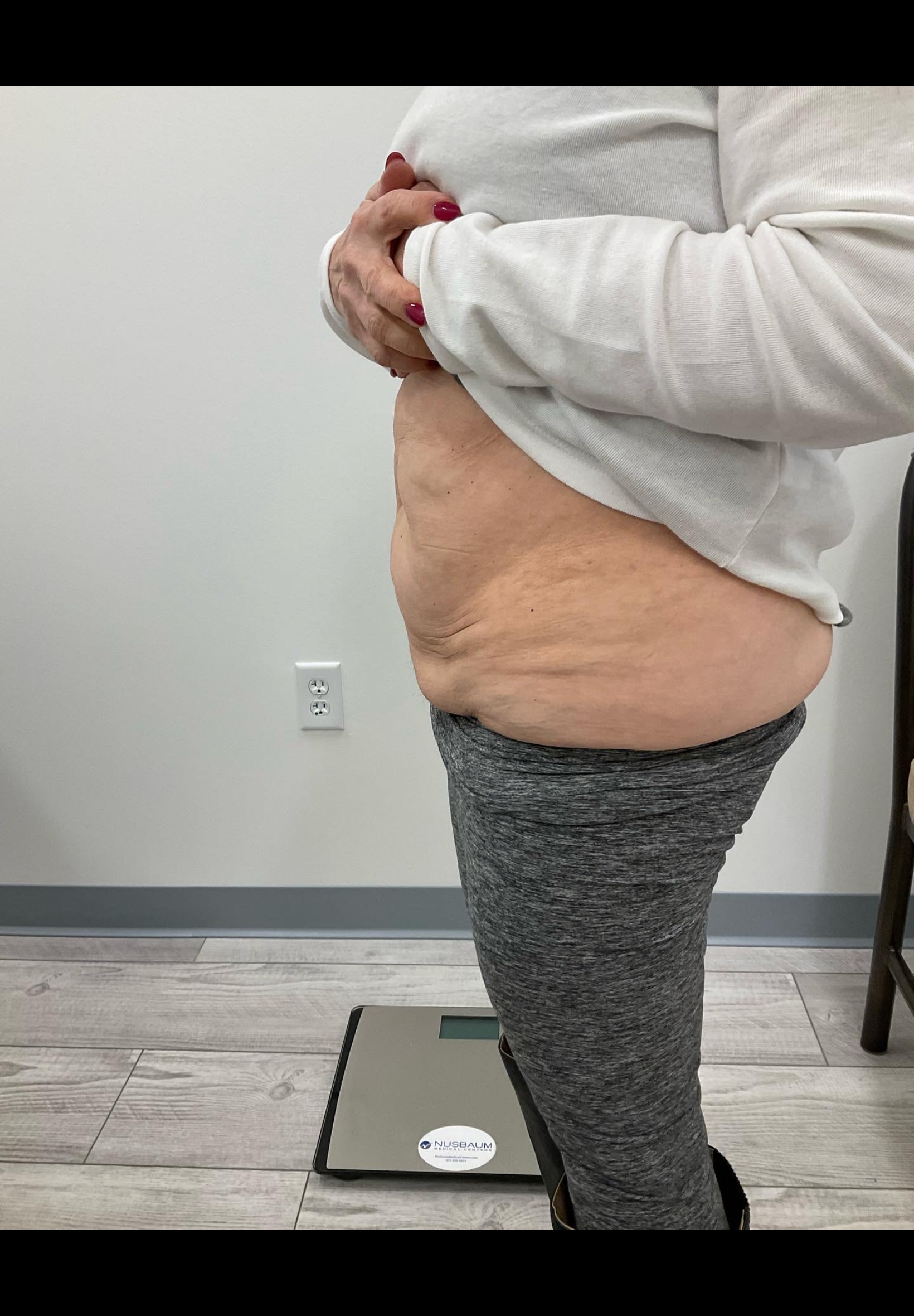 SmartLipo — after, patient 8