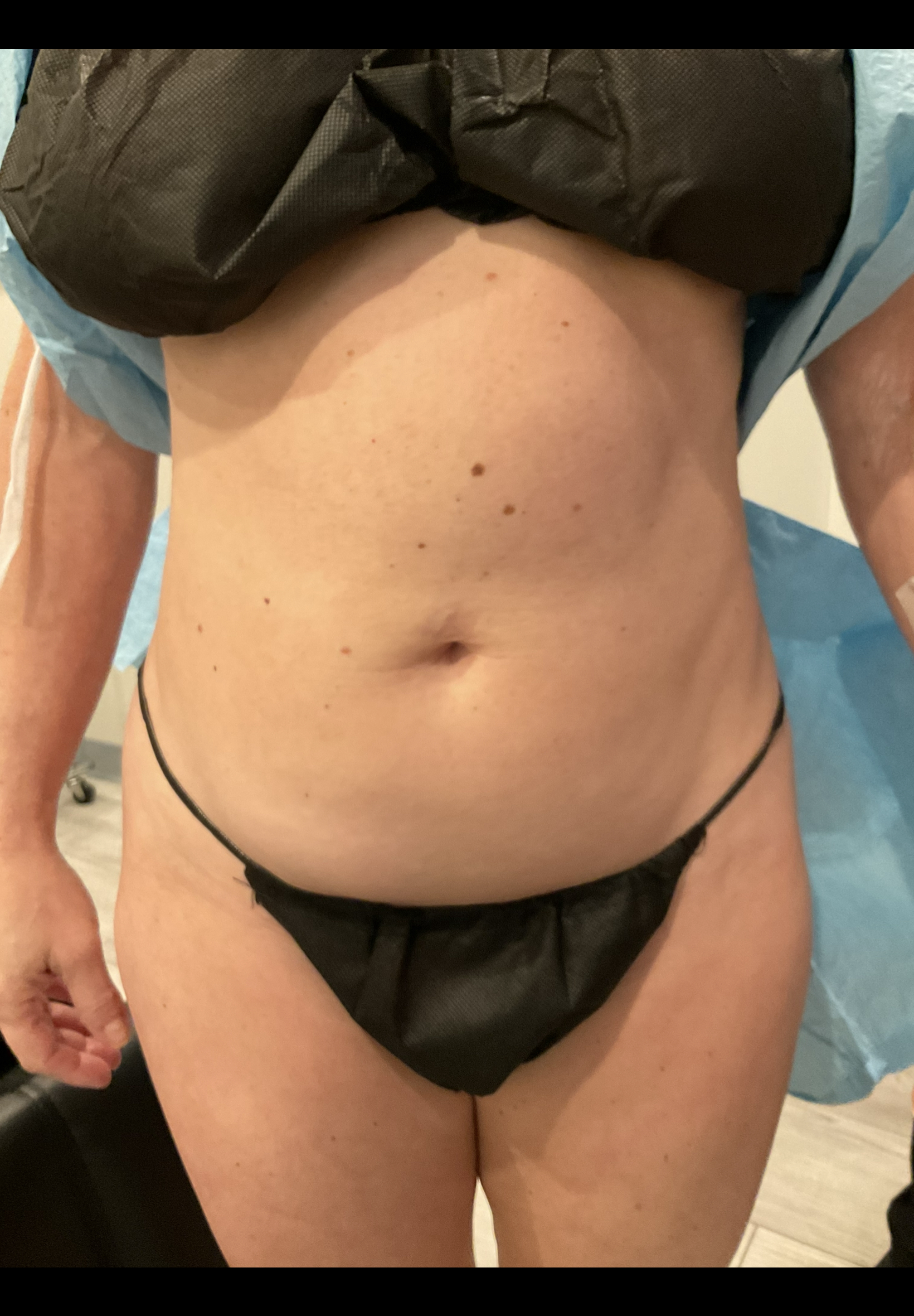 SmartLipo — before, patient 9