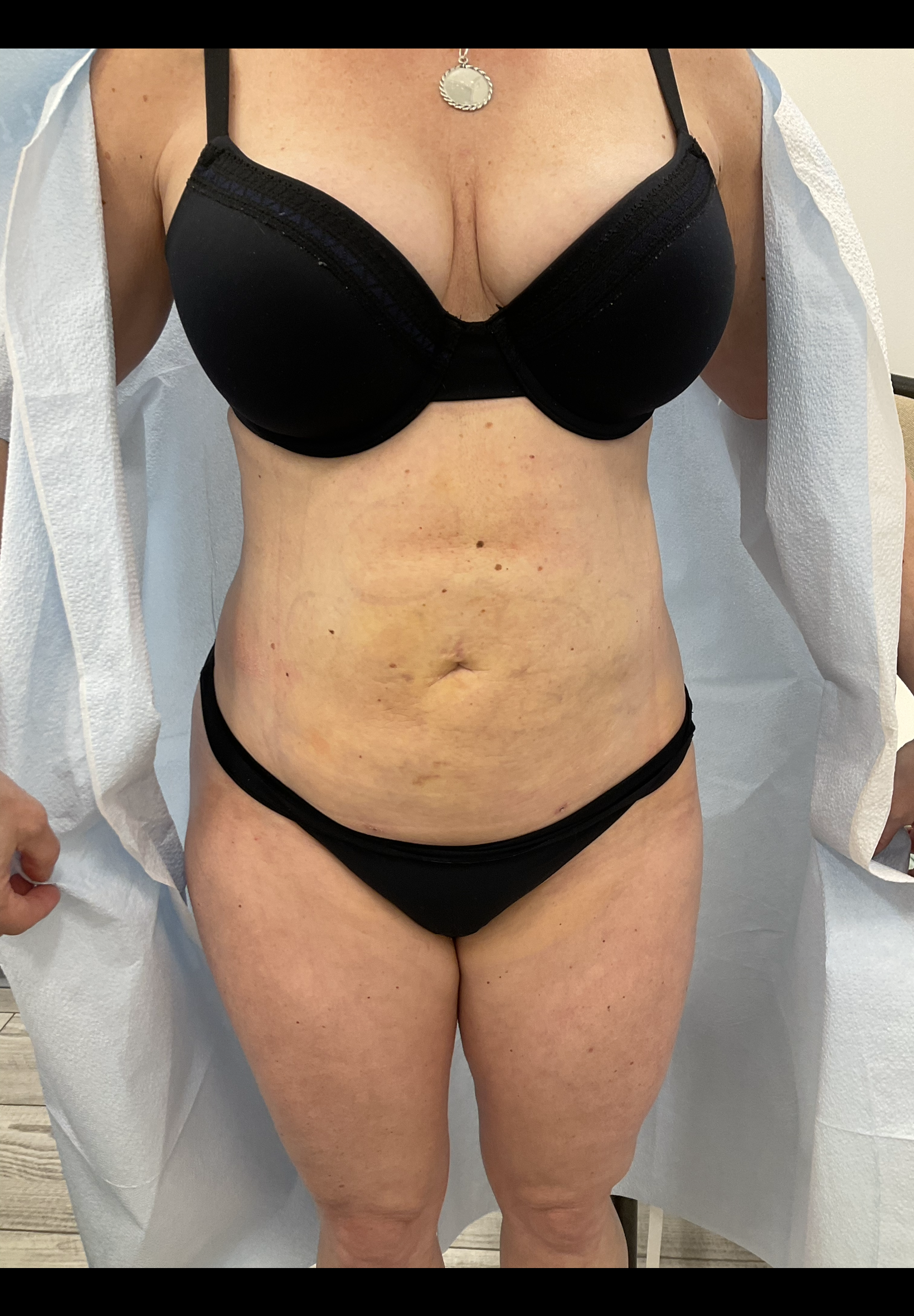 SmartLipo — after, patient 9