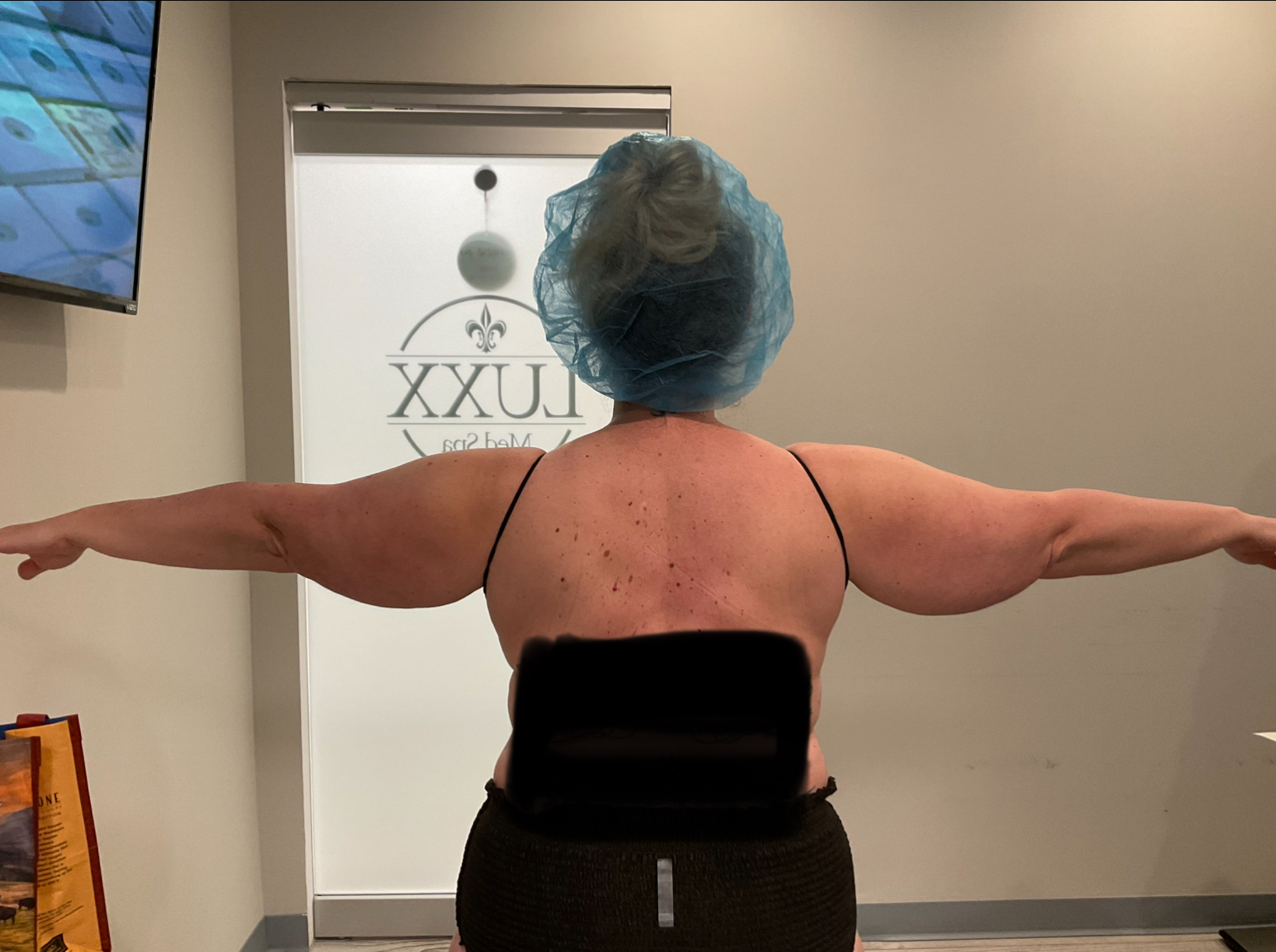 SmartLipo — before, patient 5