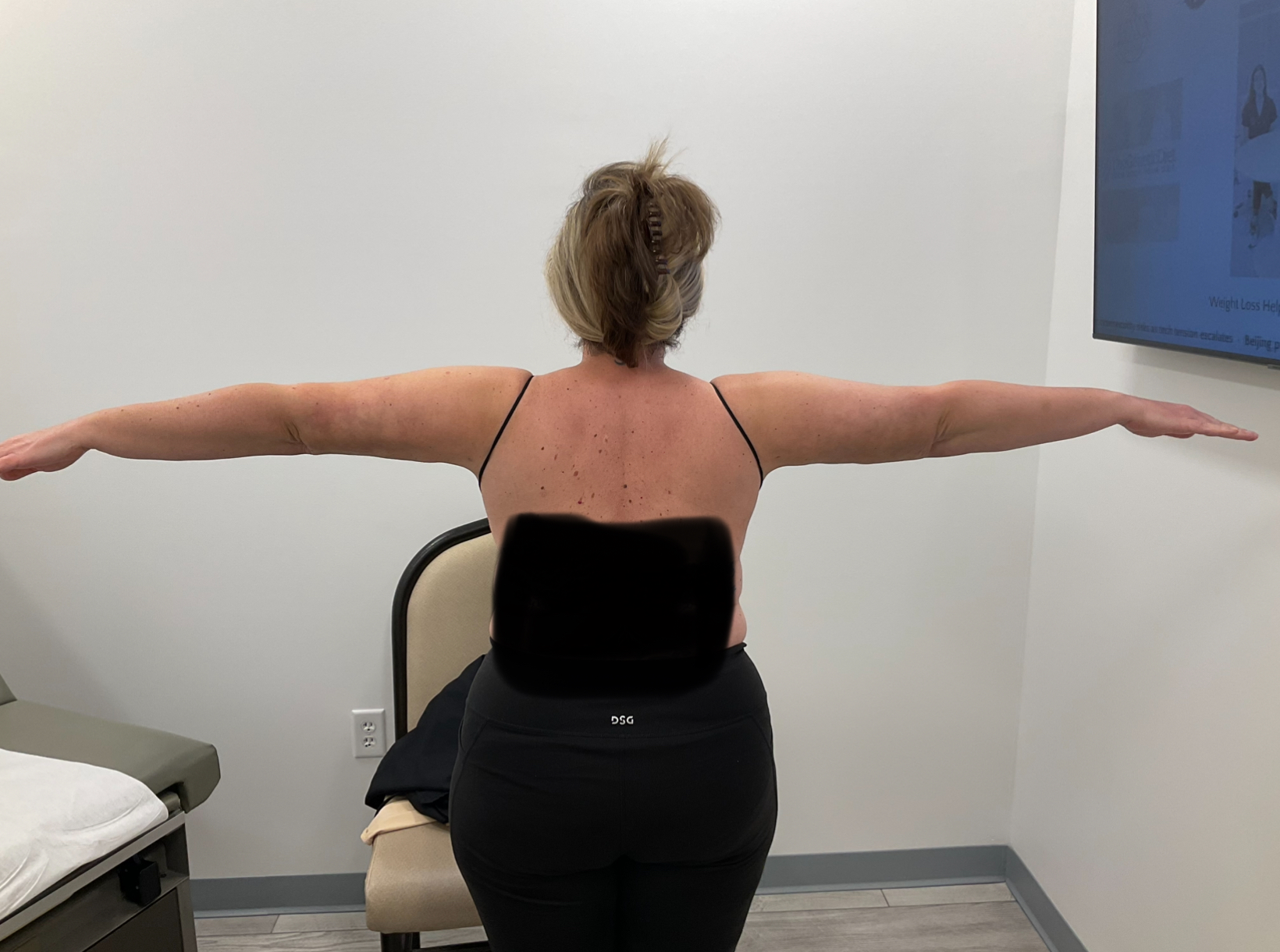 SmartLipo — after, patient 5