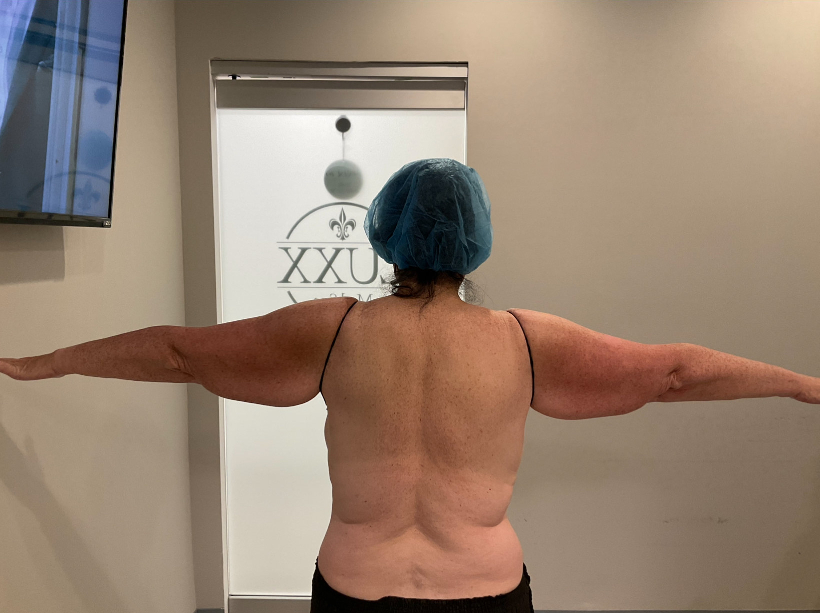SmartLipo — before, patient 6
